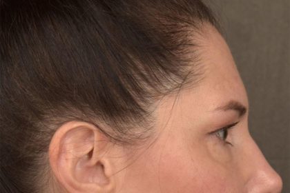 Brow Lift Before & After Patient #3291