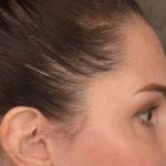 Brow Lift Before & After Patient #3291