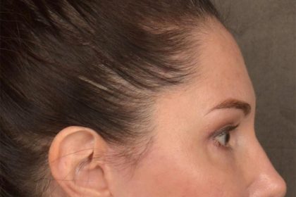 Brow Lift Before & After Patient #3291