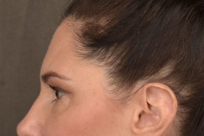 Brow Lift Before & After Patient #3291
