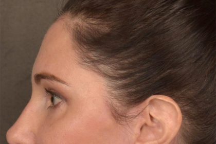 Brow Lift Before & After Patient #3291