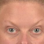 Brow Lift Before & After Patient #3292
