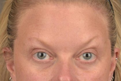 Brow Lift Before & After Patient #3292