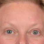 Brow Lift Before & After Patient #3292