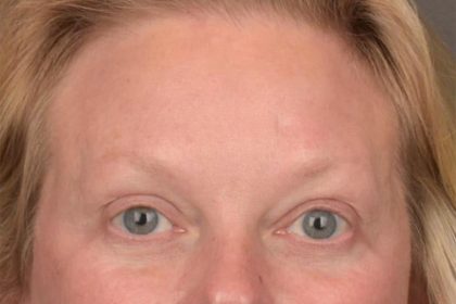 Brow Lift Before & After Patient #3292