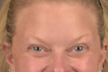 Brow Lift Before & After Patient #3292