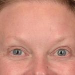 Brow Lift Before & After Patient #3292
