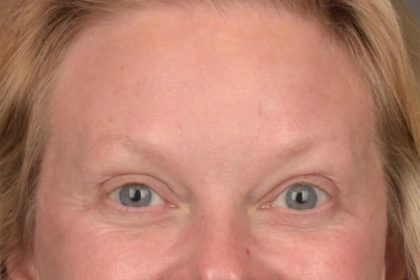 Brow Lift Before & After Patient #3292