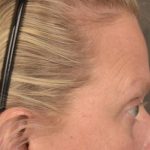 Brow Lift Before & After Patient #3292