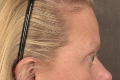Brow Lift Before & After Patient #3292