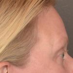 Brow Lift Before & After Patient #3292