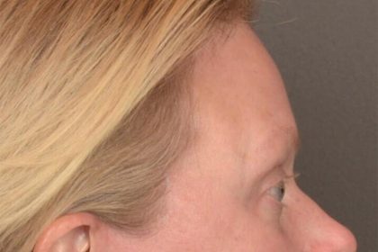 Brow Lift Before & After Patient #3292