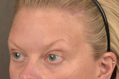 Brow Lift Before & After Patient #3292