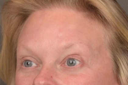 Brow Lift Before & After Patient #3292