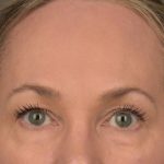 Brow Lift Before & After Patient #3293