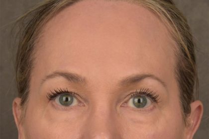 Brow Lift Before & After Patient #3293