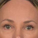 Brow Lift Before & After Patient #3293