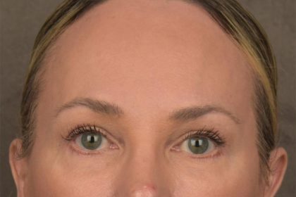 Brow Lift Before & After Patient #3293