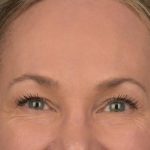 Brow Lift Before & After Patient #3293
