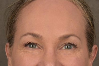 Brow Lift Before & After Patient #3293