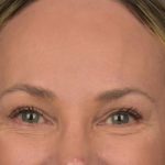 Brow Lift Before & After Patient #3293