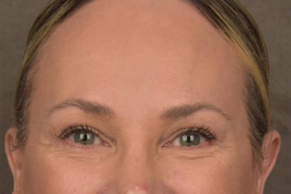 Brow Lift Before & After Patient #3293