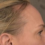 Brow Lift Before & After Patient #3293