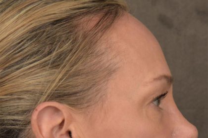 Brow Lift Before & After Patient #3293