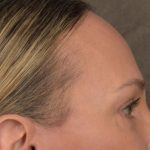 Brow Lift Before & After Patient #3293