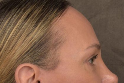 Brow Lift Before & After Patient #3293