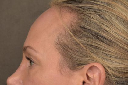 Brow Lift Before & After Patient #3293