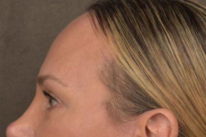 Brow Lift Before & After Patient #3293