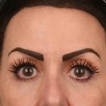 Brow Lift Before & After Patient #3294