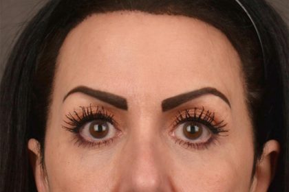 Brow Lift Before & After Patient #3294