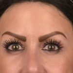 Brow Lift Before & After Patient #3294