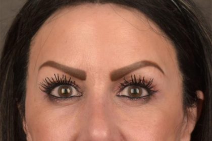 Brow Lift Before & After Patient #3294
