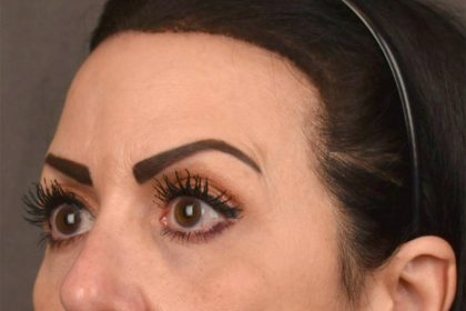 Brow Lift Before & After Patient #3294