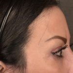 Brow Lift Before & After Patient #3294