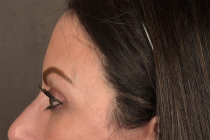 Brow Lift Before & After Patient #3294