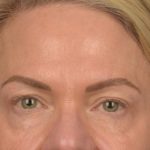 Facial Fat Grafting Before & After Patient #3295