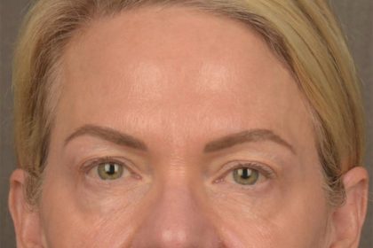 Facial Fat Grafting Before & After Patient #3295