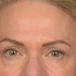 Facial Fat Grafting Before & After Patient #3295