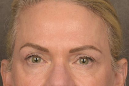 Facial Fat Grafting Before & After Patient #3295