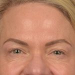 Facial Fat Grafting Before & After Patient #3295