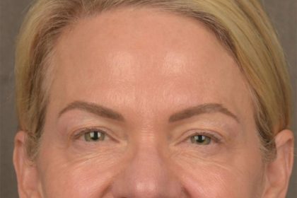 Facial Fat Grafting Before & After Patient #3295
