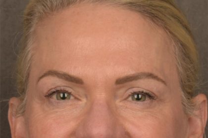 Facial Fat Grafting Before & After Patient #3295