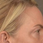 Facial Fat Grafting Before & After Patient #3295