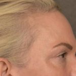 Facial Fat Grafting Before & After Patient #3295
