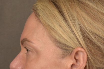 Facial Fat Grafting Before & After Patient #3295