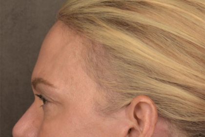 Facial Fat Grafting Before & After Patient #3295